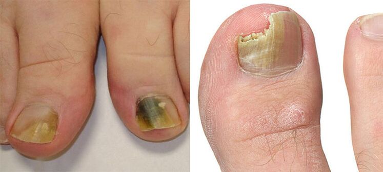 Onychomycosis - Καταστροφή νυχιών με μανιτάρι